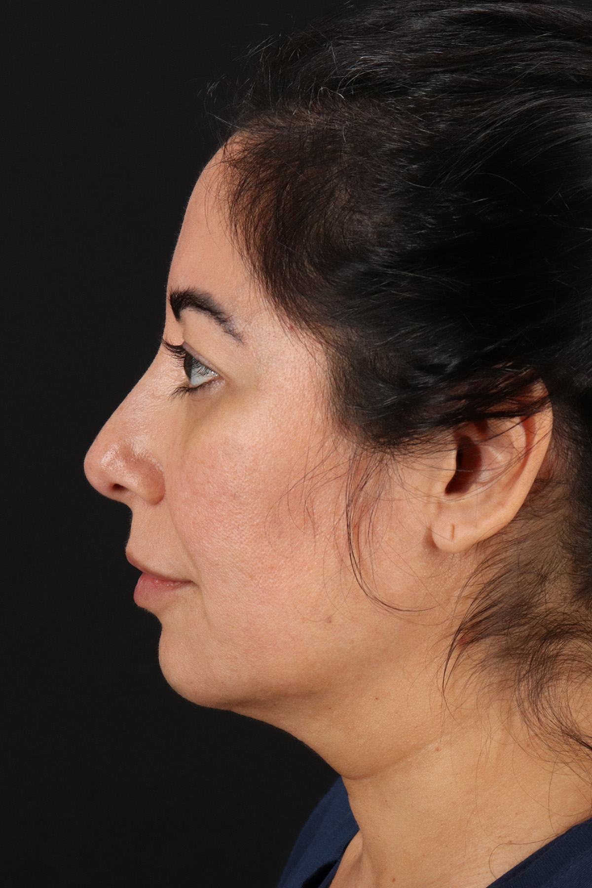 Buccal Fat Pad Before & After Patient #4666
