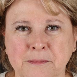 Facelift Before & After Patient #5392