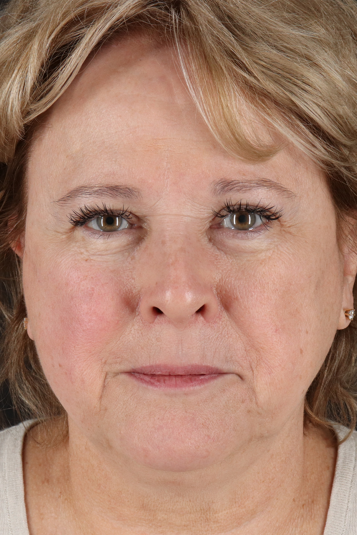 Facelift Before & After Patient #5392