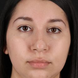 Neck Lift Before & After Patient #5395