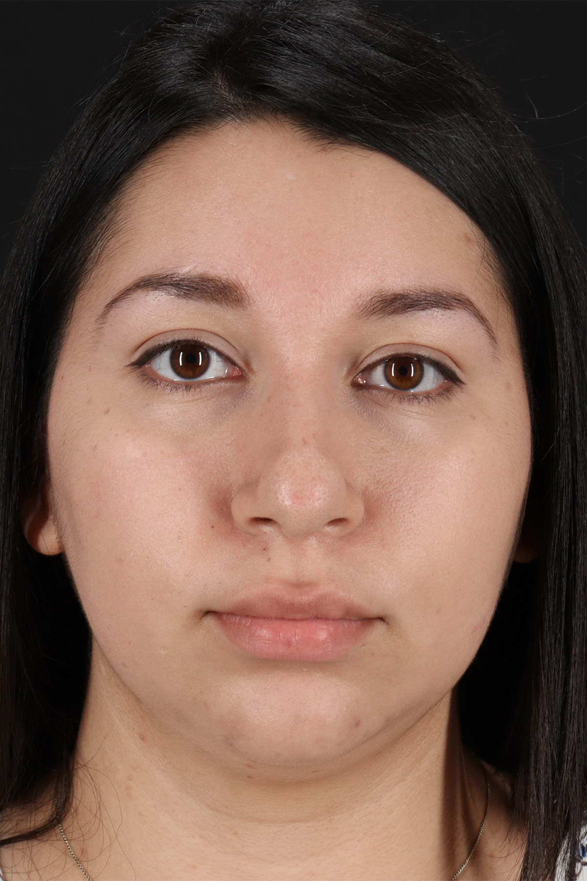 Neck Lift Before & After Patient #5395