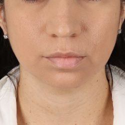 Neck Lift Before & After Patient #5396