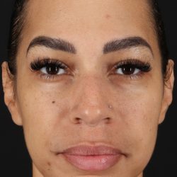 Chin Implant Before & After Patient #5390