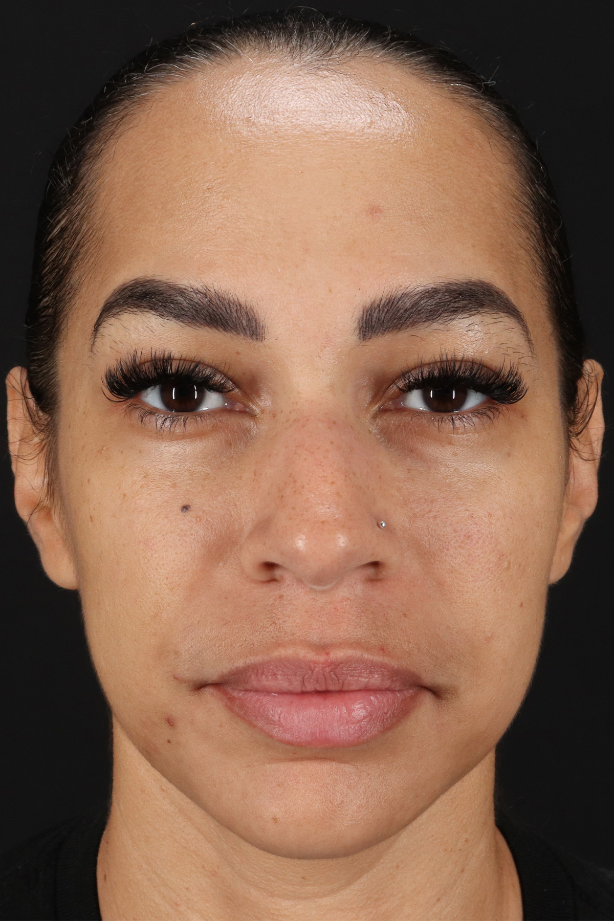Chin Implant Before & After Patient #5390