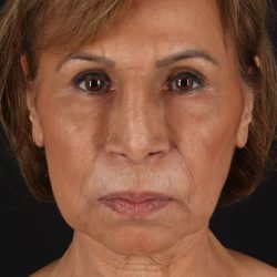 Facelift Before & After Patient #5394