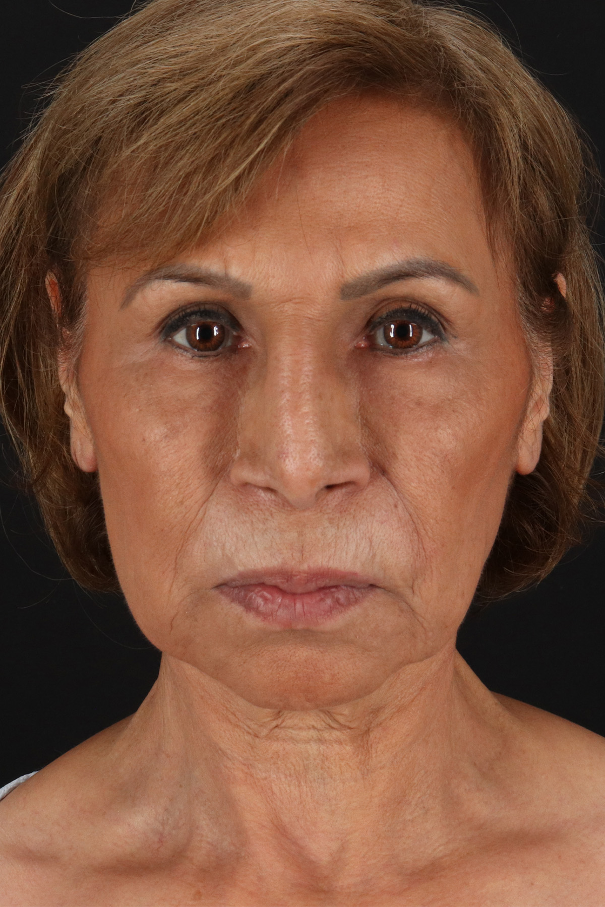 Facelift Before & After Patient #5394