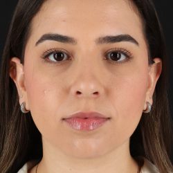 Chin Implant Before & After Patient #5391