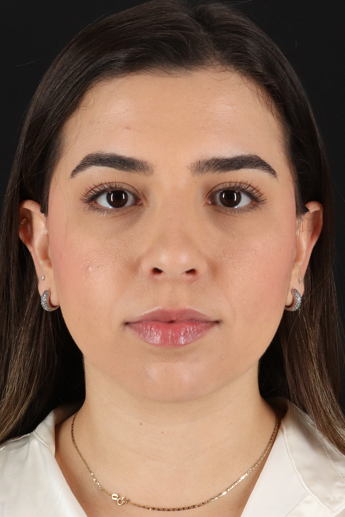 Chin Implant Before & After Patient #5391