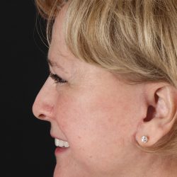 Neck Lift Before & After Patient #5393