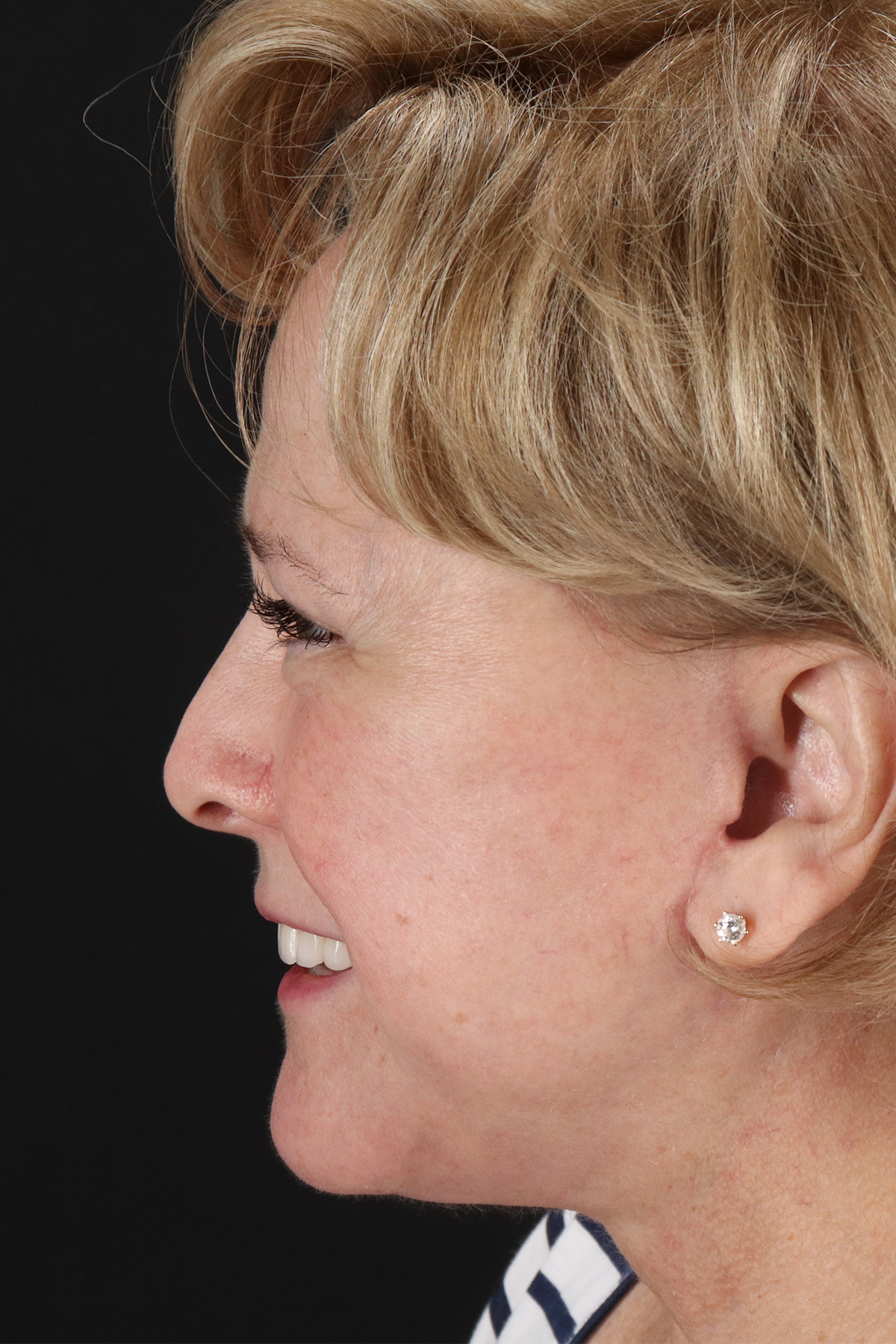 Facelift Before & After Patient #5392