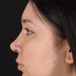 Neck Lift Before & After Patient #5395