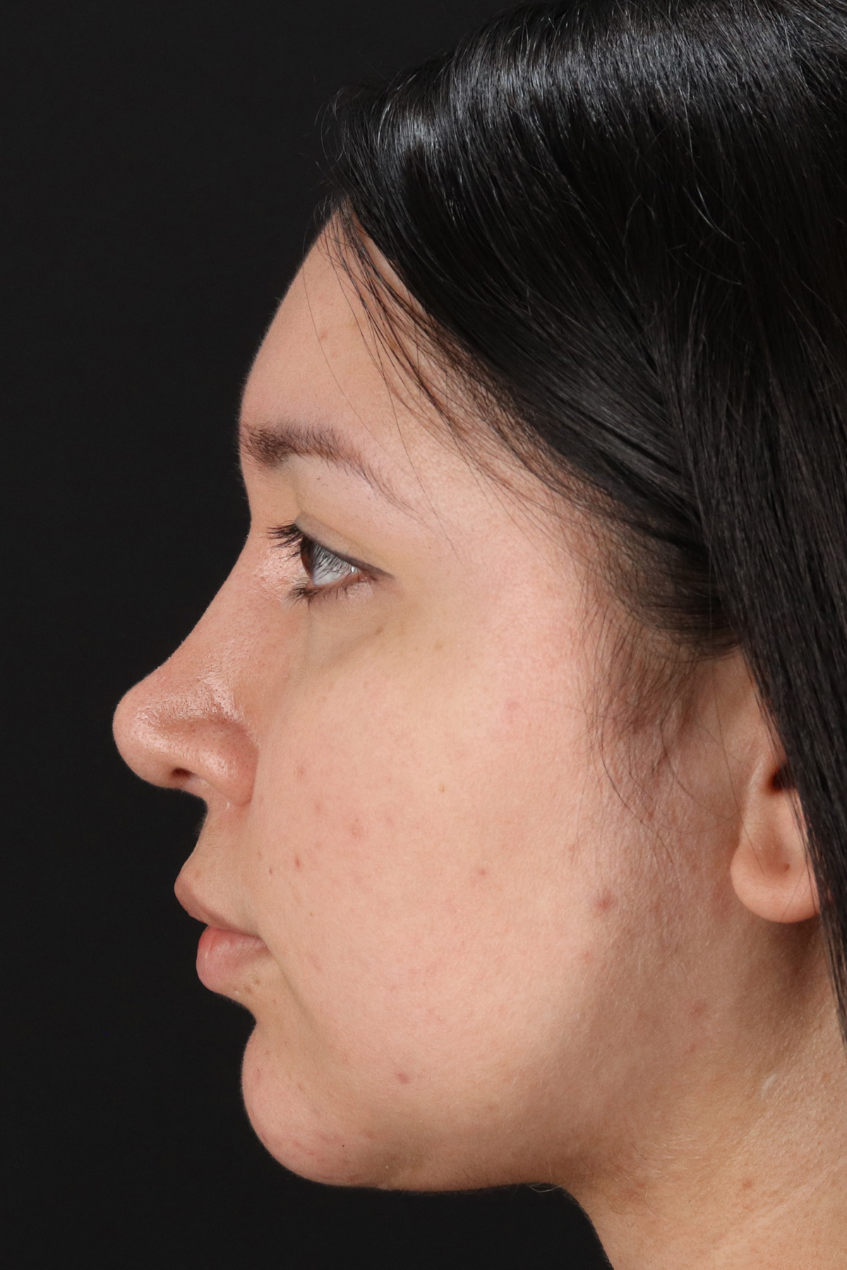 Neck Lift Before & After Patient #5395