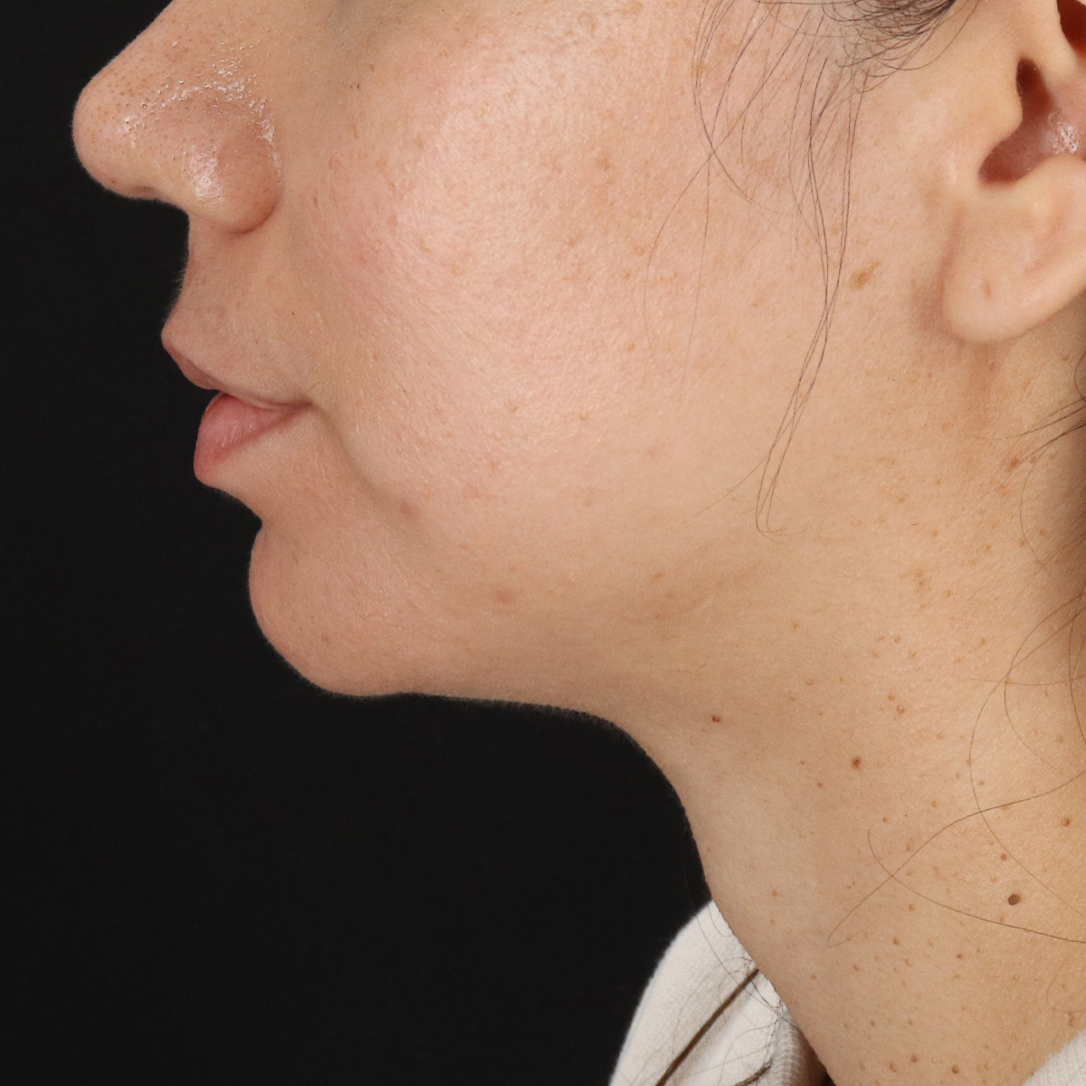 Neck Lift Before & After Patient #5396