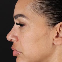 Chin Implant Before & After Patient #5390