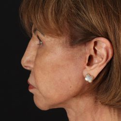 Facelift Before & After Patient #5394