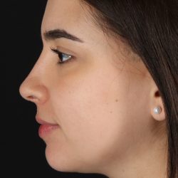 Chin Implant Before & After Patient #5391