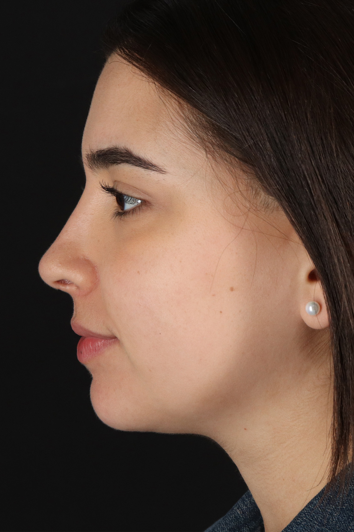 Chin Implant Before & After Patient #5391