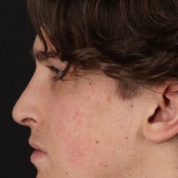 Rhinoplasty Before & After Patient #5515