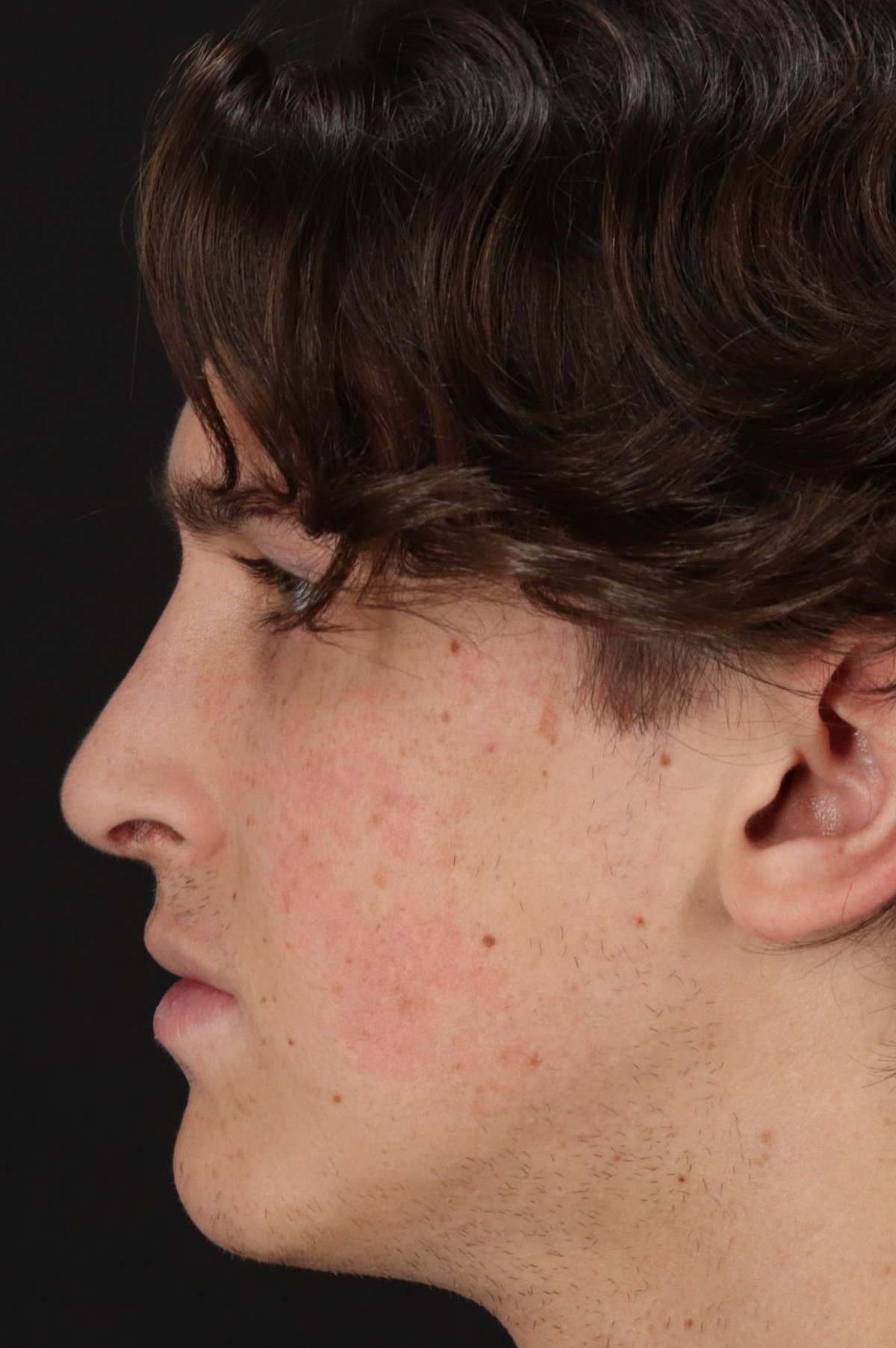 Rhinoplasty Before & After Patient #5515
