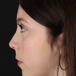 Rhinoplasty Before & After Patient #5575