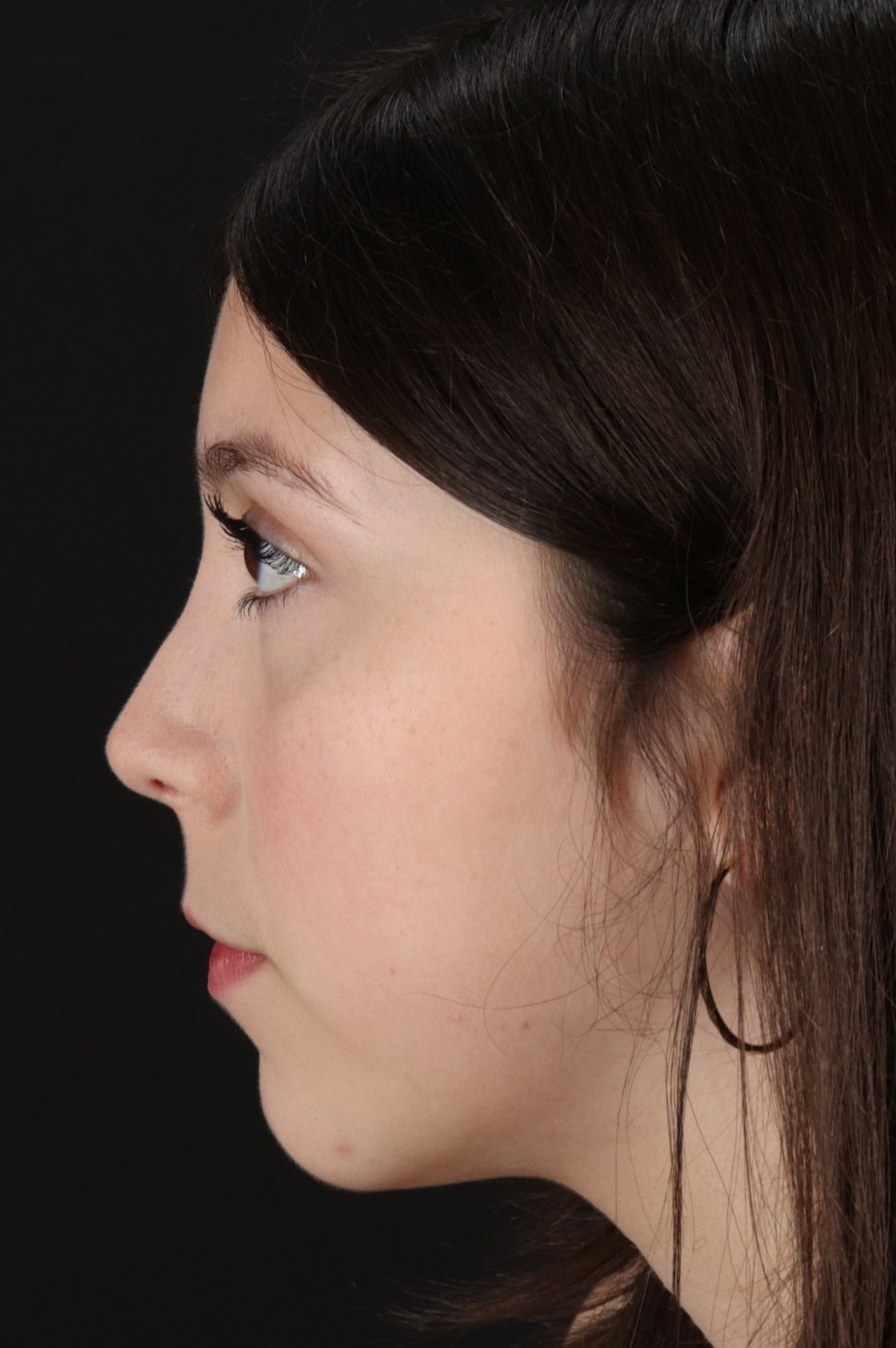 Rhinoplasty Before & After Patient #5575