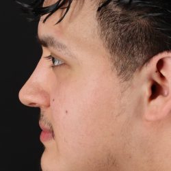 Rhinoplasty Before & After Patient #5516