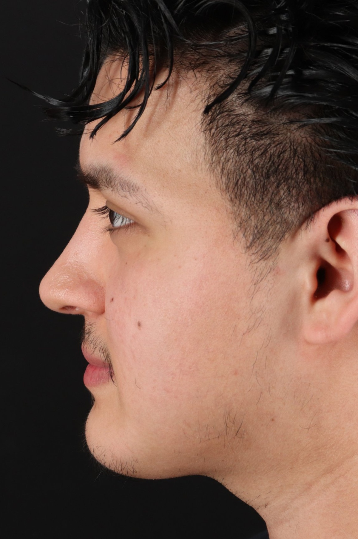 Rhinoplasty Before & After Patient #5516
