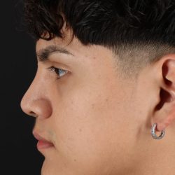 Rhinoplasty Before & After Patient #5517