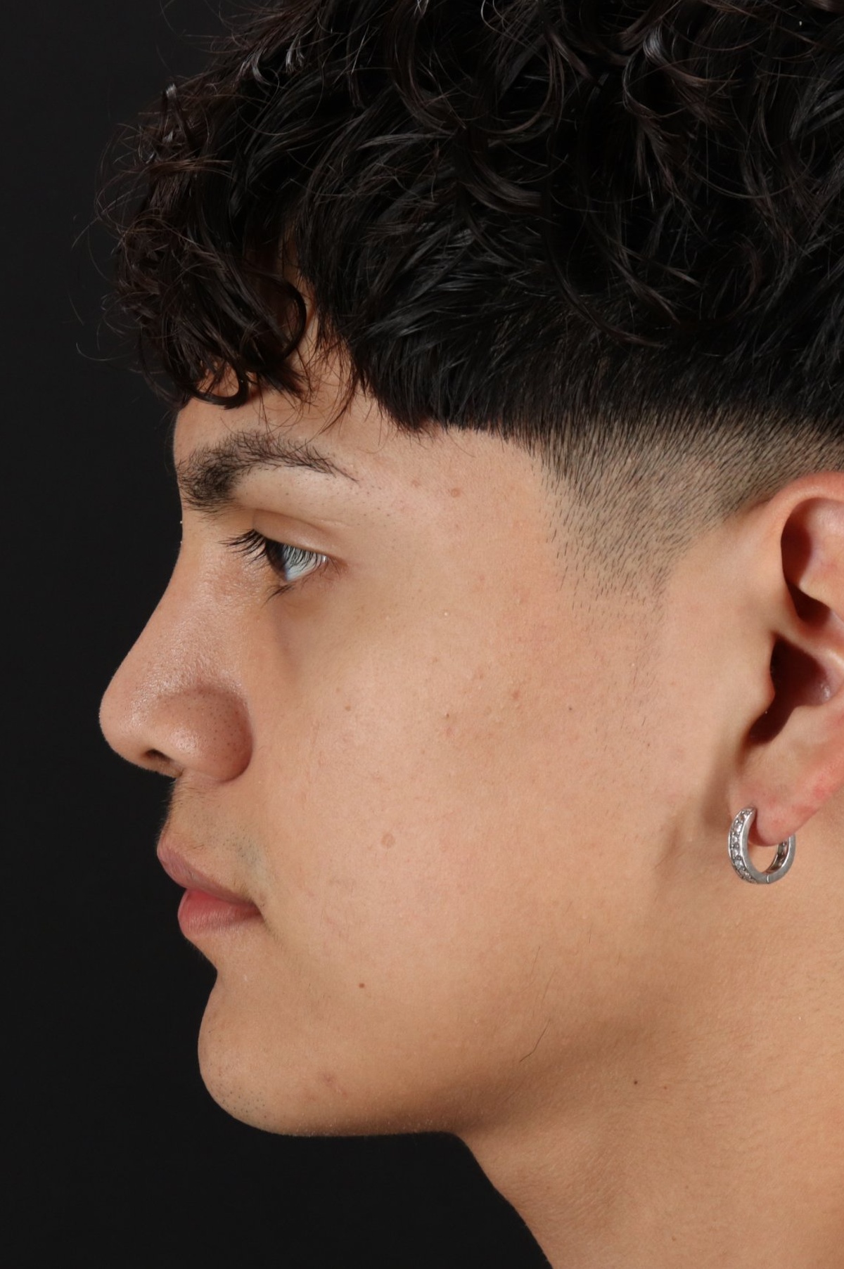 Rhinoplasty Before & After Patient #5517