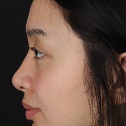 Rhinoplasty Before & After Patient #5573