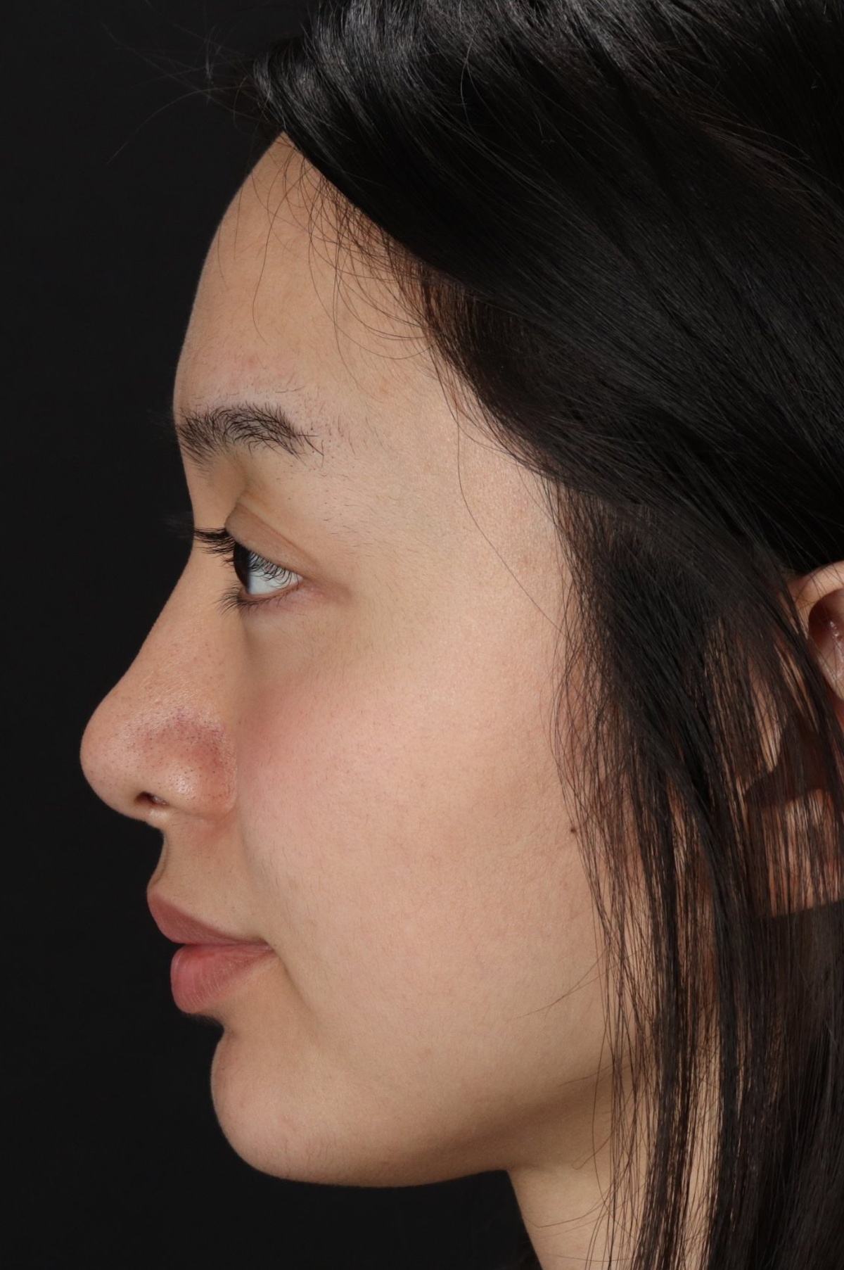 Rhinoplasty Before & After Patient #5573