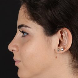 Rhinoplasty Before & After Patient #5572