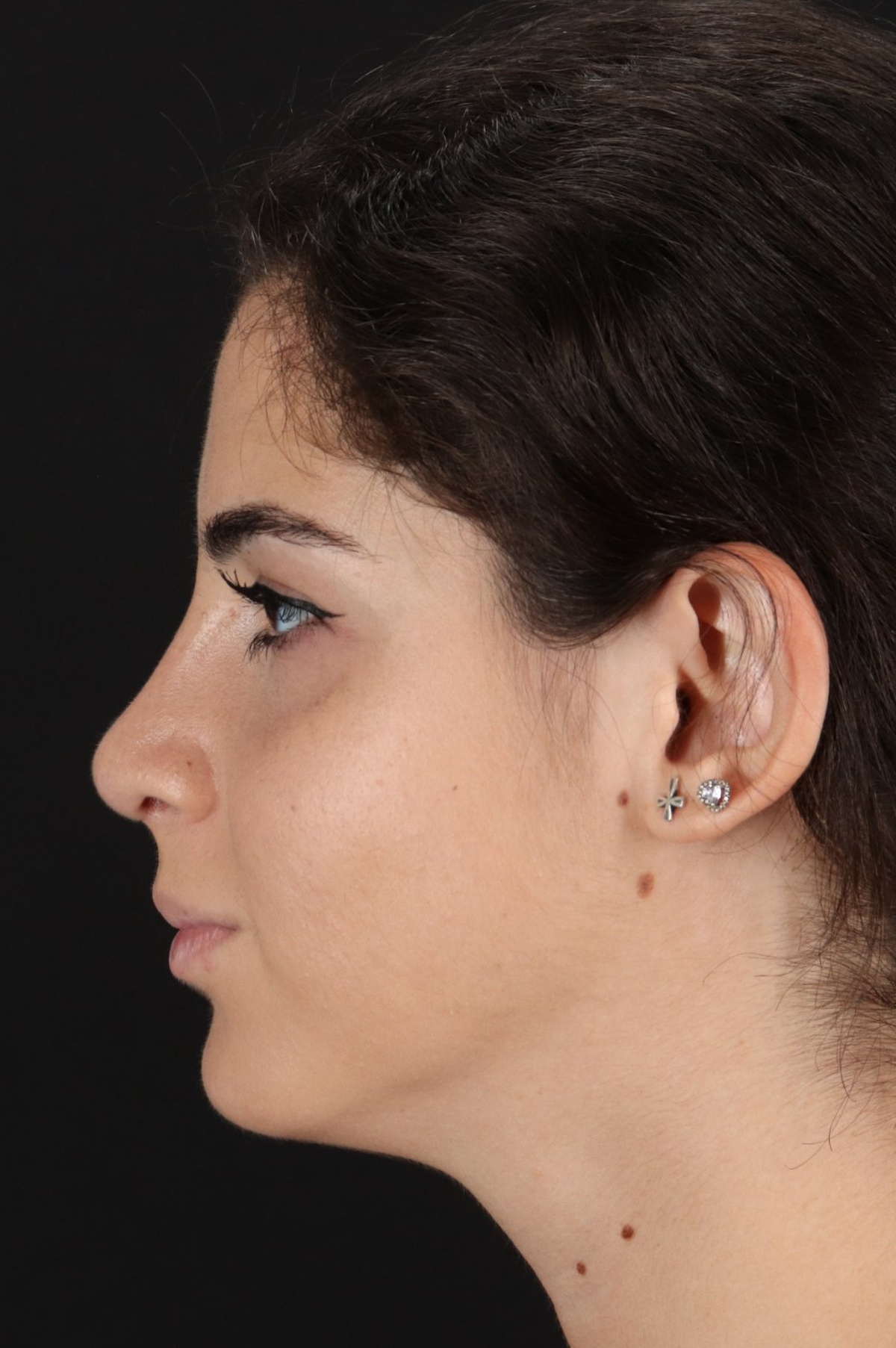 Rhinoplasty Before & After Patient #5572