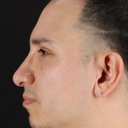 Rhinoplasty Before & After Patient #5518