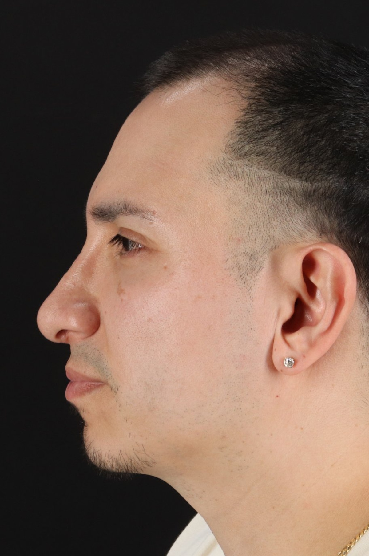 Rhinoplasty Before & After Patient #5518