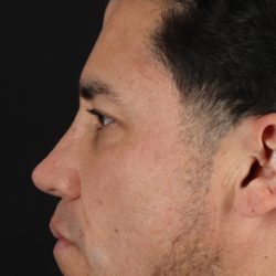 Rhinoplasty Before & After Patient #5519