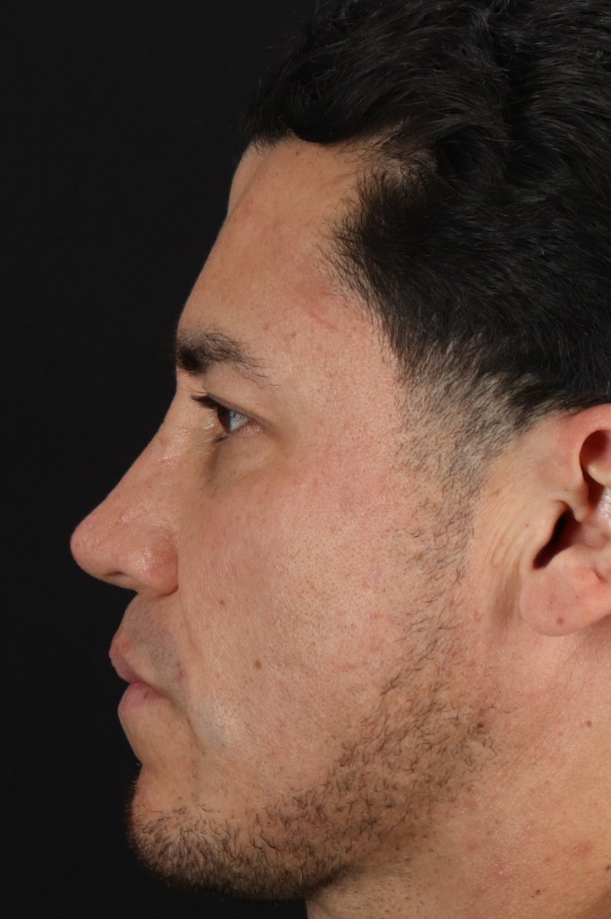 Rhinoplasty Before & After Patient #5519
