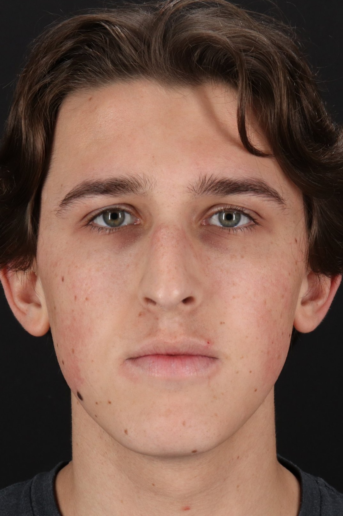Rhinoplasty Before & After Patient #5515