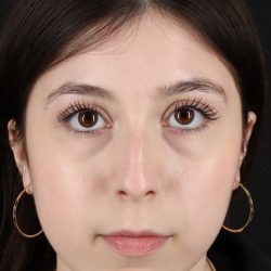 Rhinoplasty Before & After Patient #5575