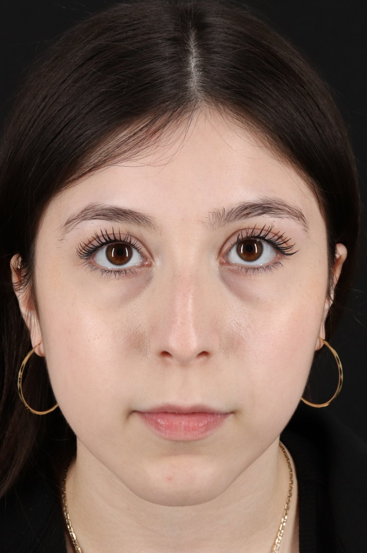 Rhinoplasty Before & After Patient #5575