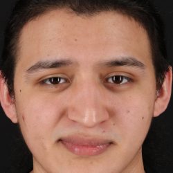Rhinoplasty Before & After Patient #5516