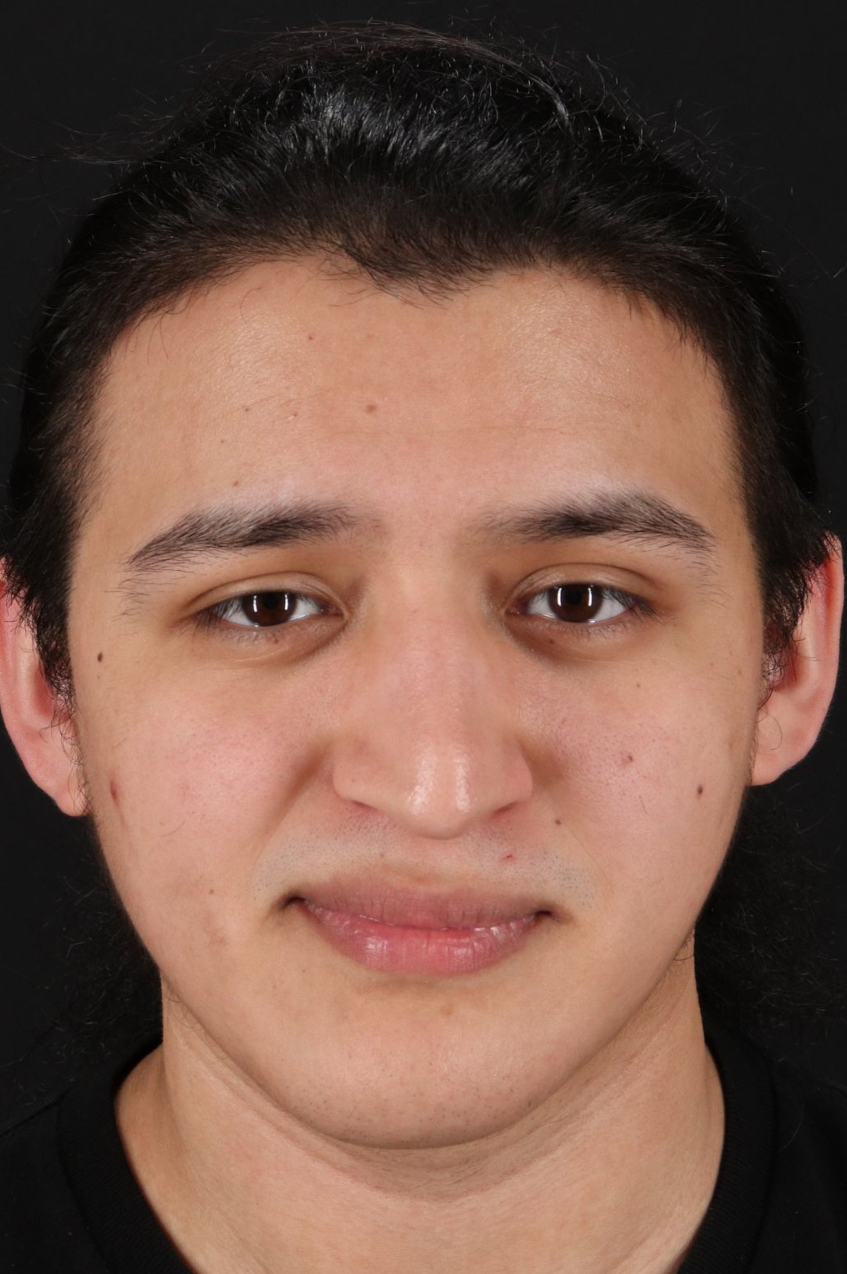 Rhinoplasty Before & After Patient #5516