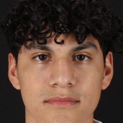 Rhinoplasty Before & After Patient #5517