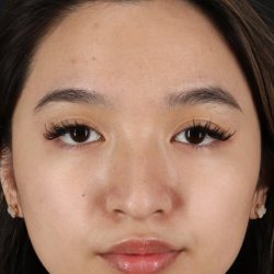 Rhinoplasty Before & After Patient #5573