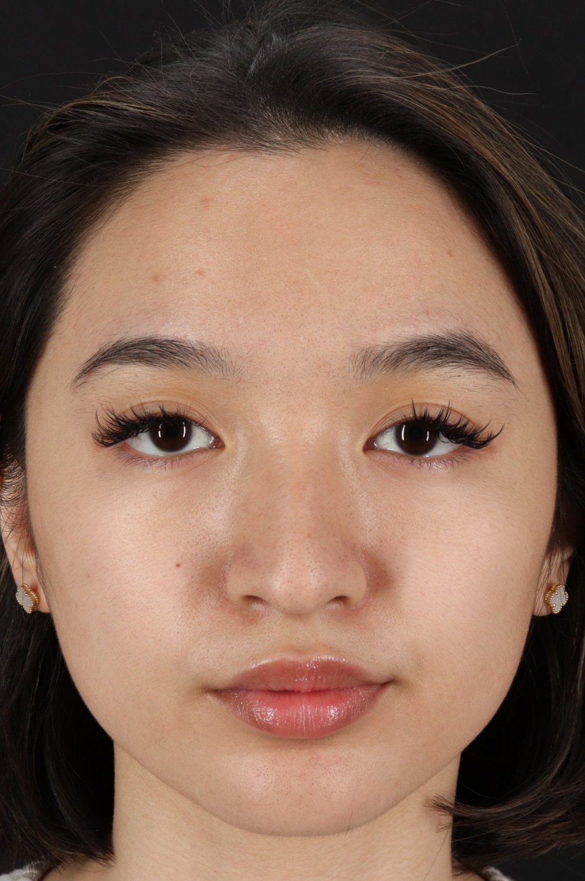 Rhinoplasty Before & After Patient #5573