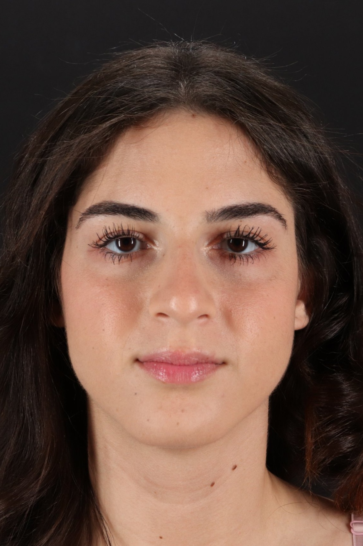 Rhinoplasty Before & After Patient #5572