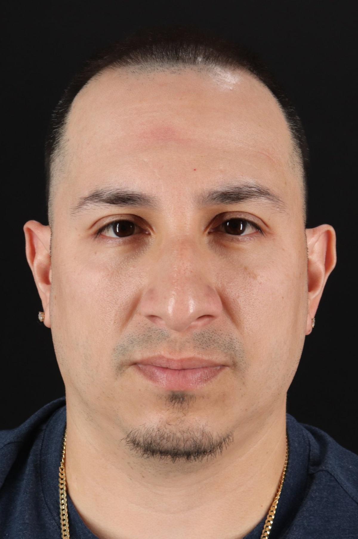 Rhinoplasty Before & After Patient #5518