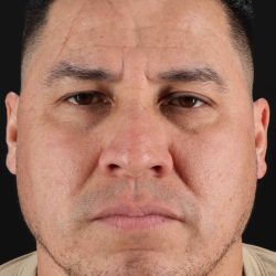 Rhinoplasty Before & After Patient #5519
