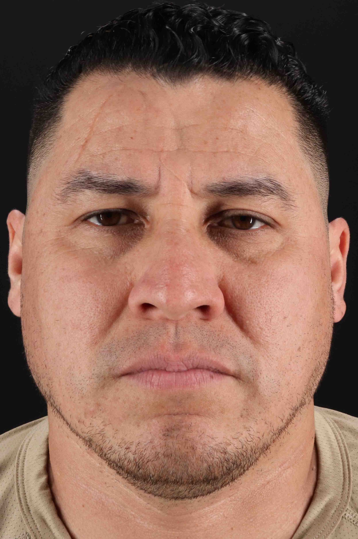 Rhinoplasty Before & After Patient #5519