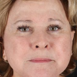 Neck Lift Before & After Patient #5393
